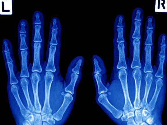 Hand X ray